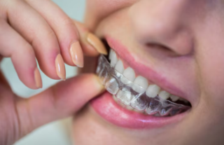 The Role Of Custom Fit In Successful Clear Aligner Treatment