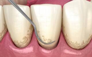 Why a Periodontist May Recommend Deep Cleaning for Gum Health