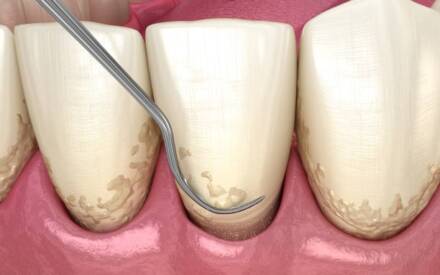 Why a Periodontist May Recommend Deep Cleaning for Gum Health