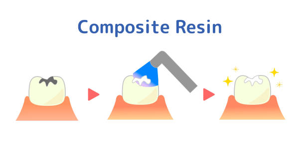 Innovations in Dental Composites: Advancing Tooth Restoration