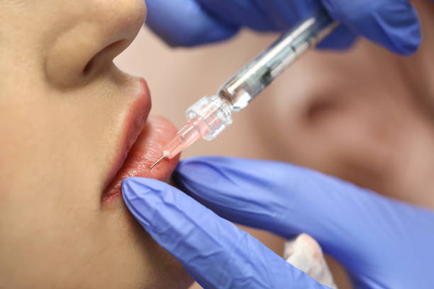 What to Expect from a Lip Filler Treatment in Scottsdale