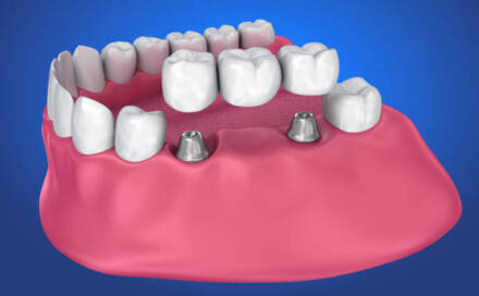 3 Reasons Patients Choose Dental Implants Over Bridges