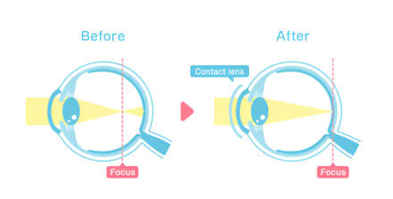 Refractive Lens Exchange for Cataract Prevention
