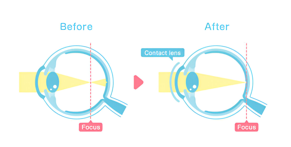 Refractive Lens Exchange for Cataract Prevention