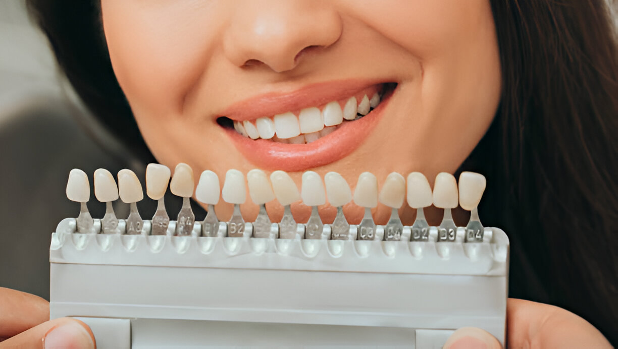 Are Dental Veneers Right for You? Here’s What You Need to Know