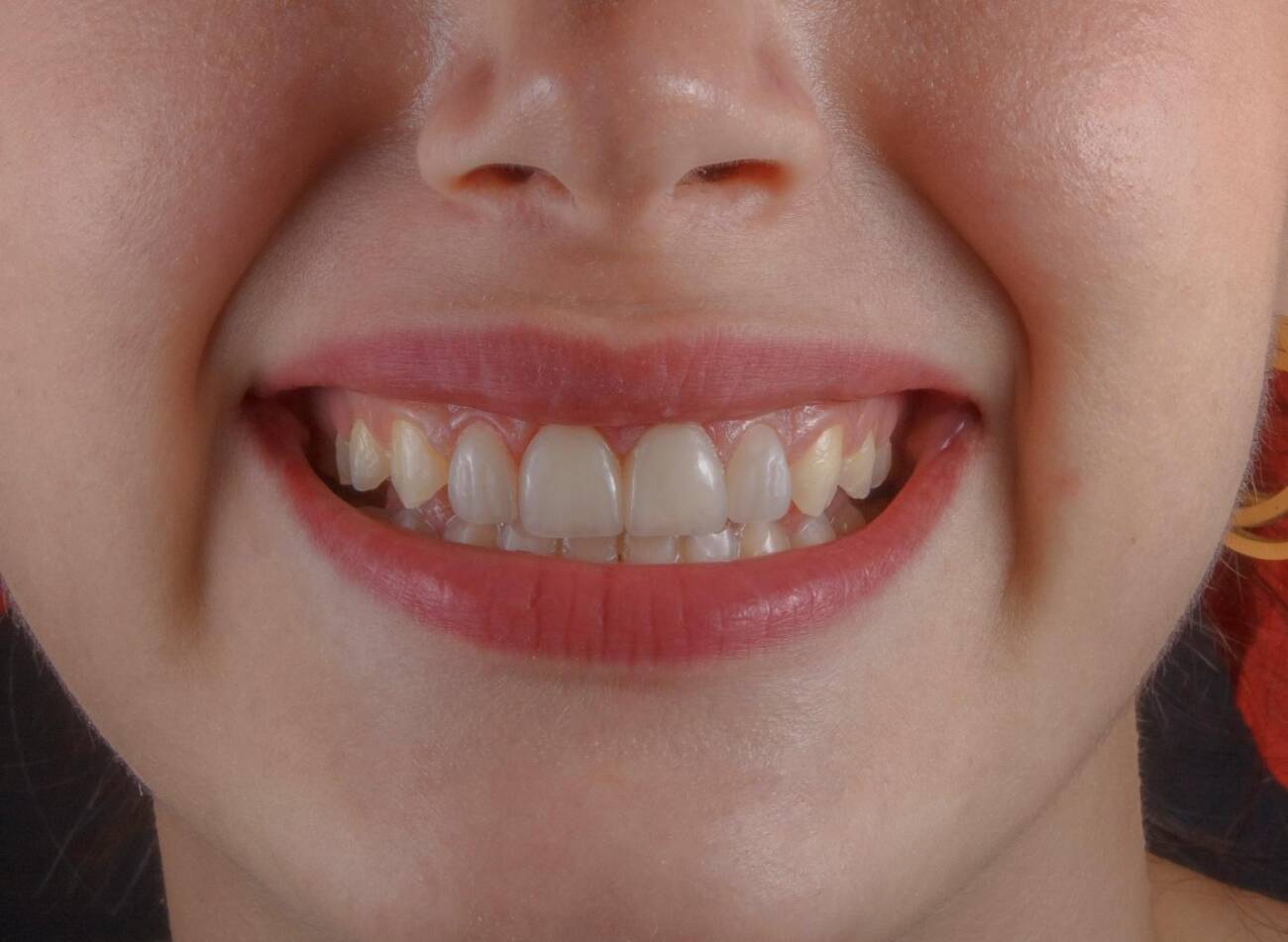 What Role Does Diet Play in Maintaining Healthy Teeth and Gums?