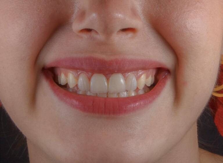 What Role Does Diet Play in Maintaining Healthy Teeth and Gums?